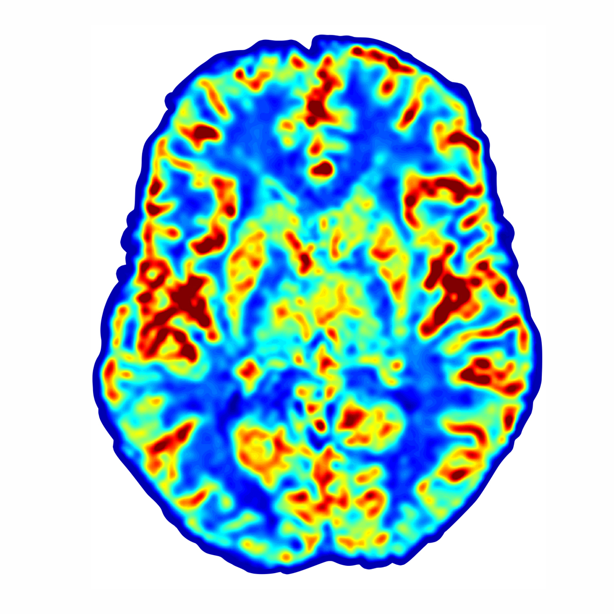 SPECT Scan of Human Brain